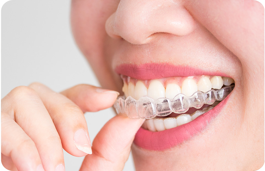 Affordable Aligners and Braces for Teeth Alignment | Invisalign, Metal, and Clear Braces Solutions - The Smile Spa Dental Clinic