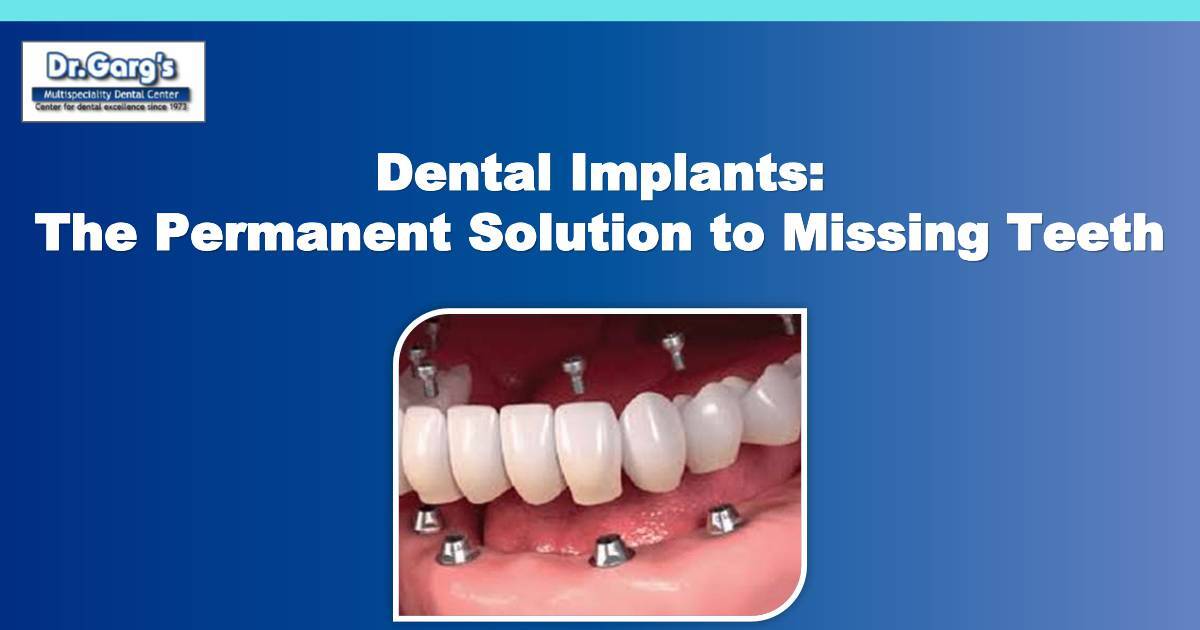 Dental Implants: The Permanent Solution to Missing Teeth |