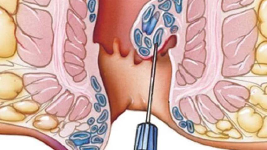 Infrared Photocoagulation for Hemorrhoids: A Non-Surgical Solution by Dr. Raviram S.