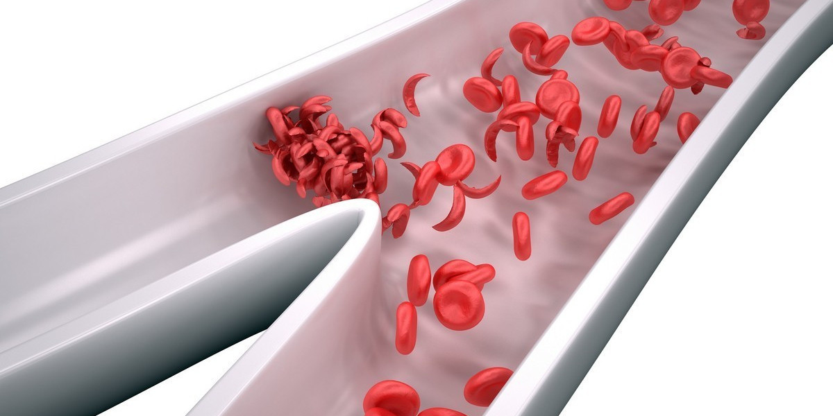 Sickle Cell Disease Treatment: New Drugs and Therapies on the Horizon