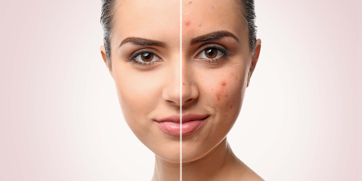 Combining Treatments for Effective Acne Scar Removal in Islamabad