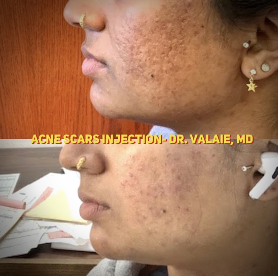 Scars & Acne Scars Injection | Orange County | Dr. Valaie, MD