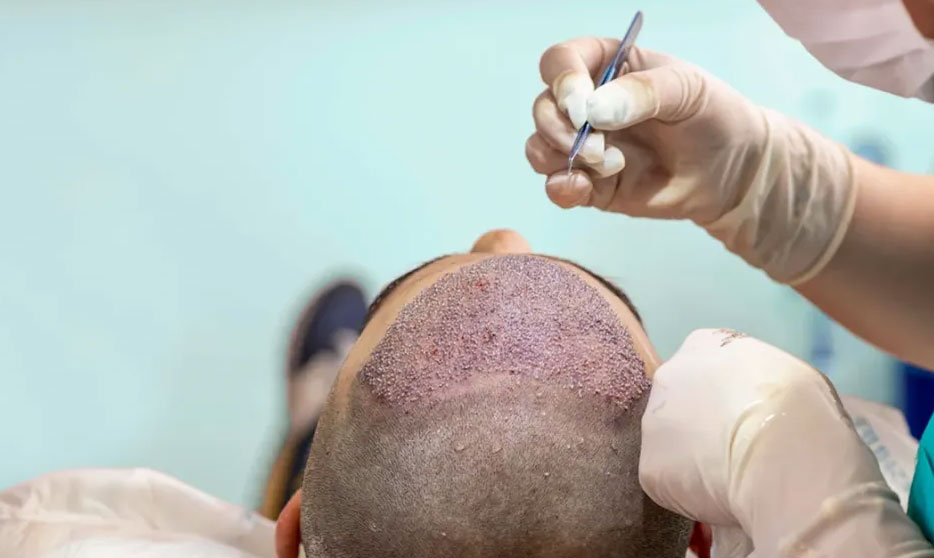 Best Hair Transplant in Delhi | Dermasure Clinic