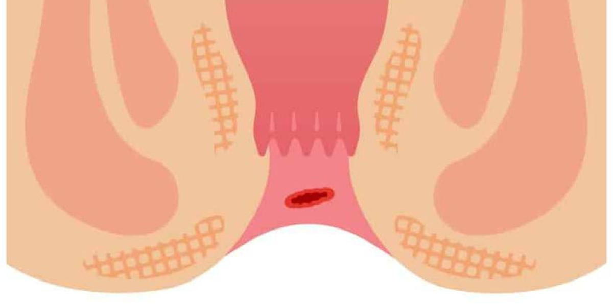 How to Identify Symptoms of Hemorrhoids vs. Anal Fissures