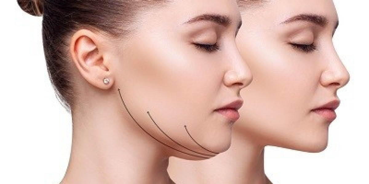 Best Double Chin Removal Treatments in Islamabad