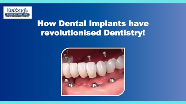 How Dental Implants have revolutionised Dentistry | Pearltrees