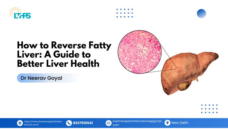 How to Reverse Fatty Liver: A Guide t Better Liver Health: drneerav — LiveJournal