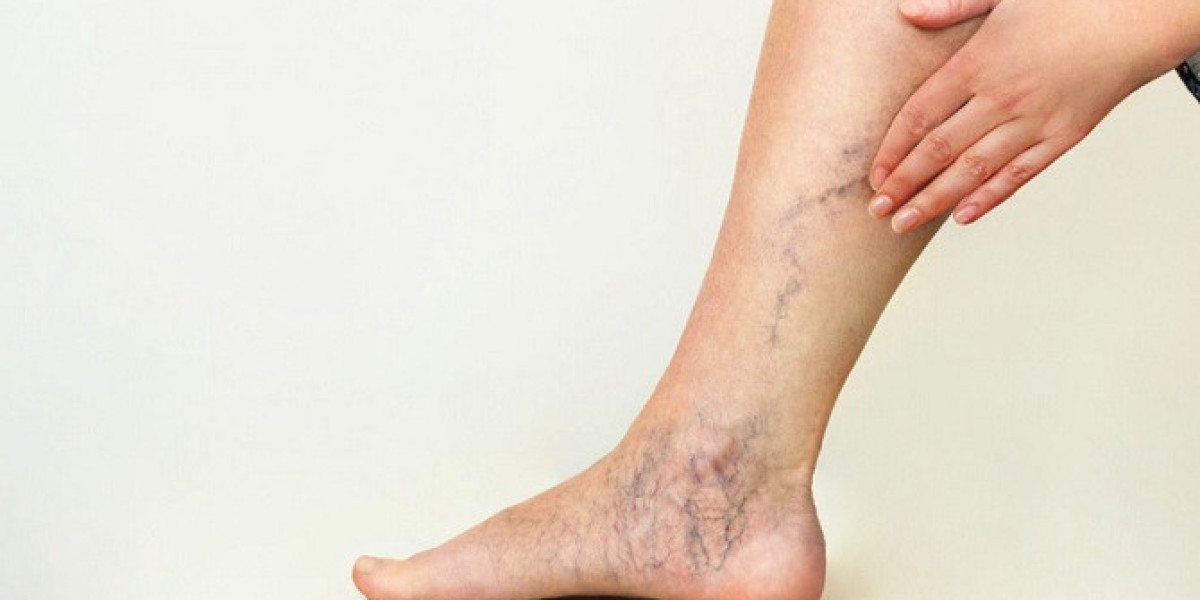 Will spider veins fade?