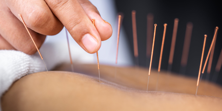 Unlocking Wellness: The Benefits of Acupuncture in New Westminster : newwestminsterp — LiveJournal