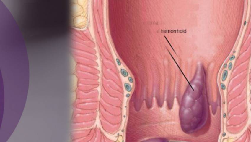 Know the Difference Between Piles, Fissures, and Fistula | Dr. Raviram S.