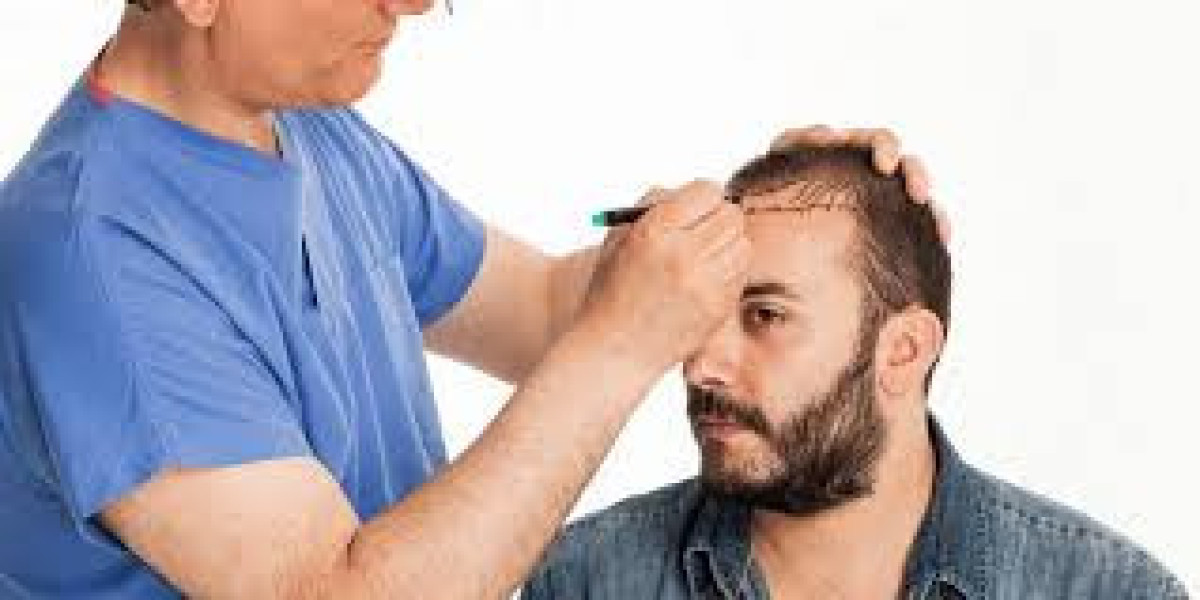 Stop Hiding and Start Living – Hair Transplants in Riyadh