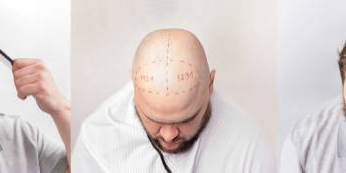 New Year, New You? Get a Hair Transplant for a Fresh Start!