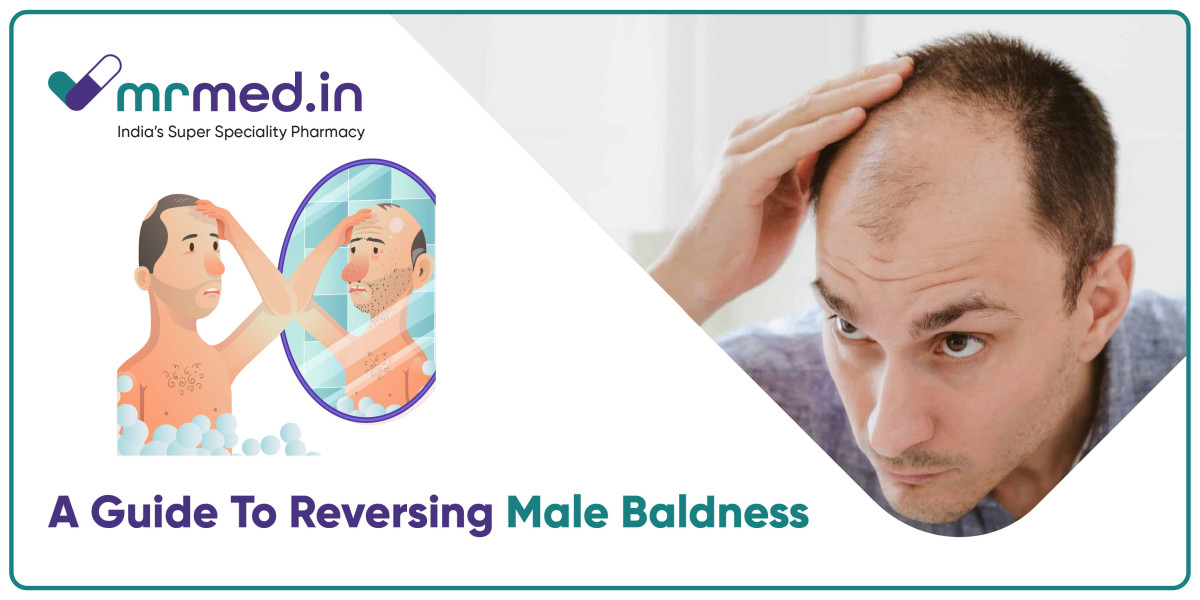 Top Treatments for Preventing and Reversing Male Pattern Baldness