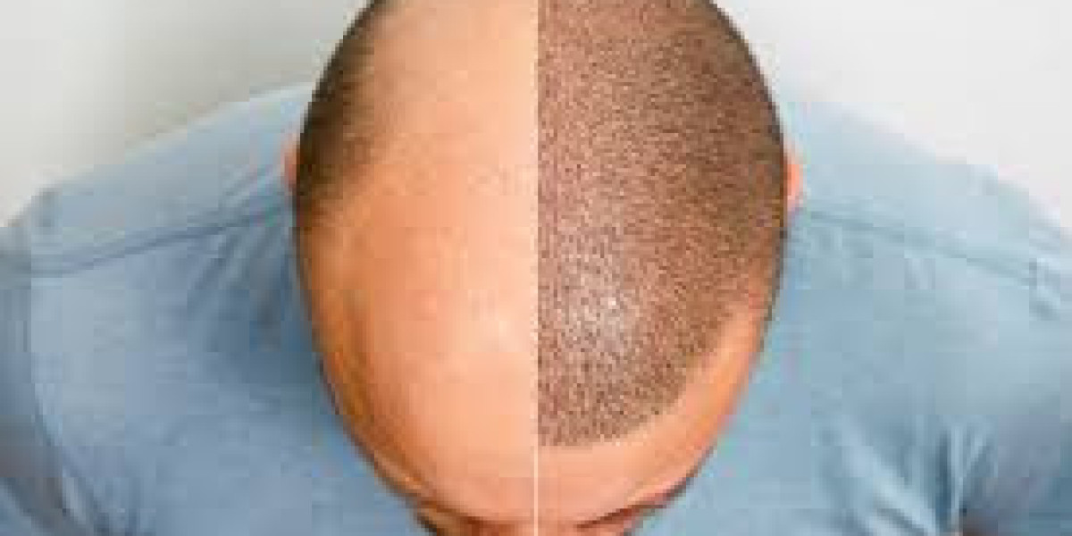 Best Hair Transplant Surgeons in Riyadh: What You Need to Know