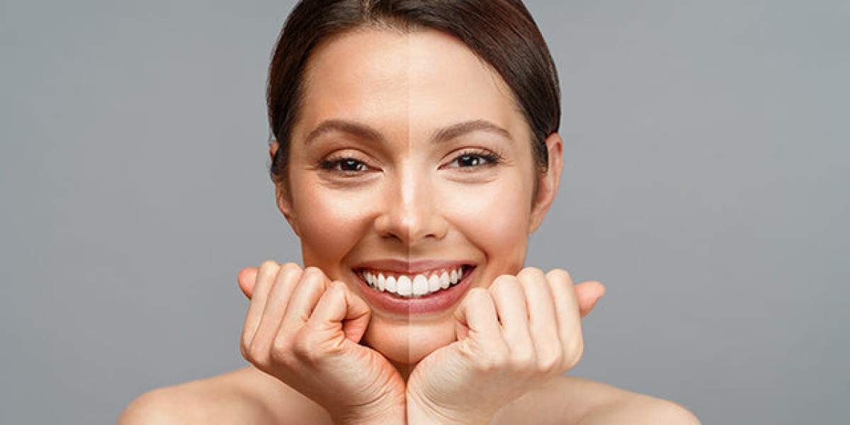 Skin Whitening in Dubai: A Growing Trend in Beauty and Wellness