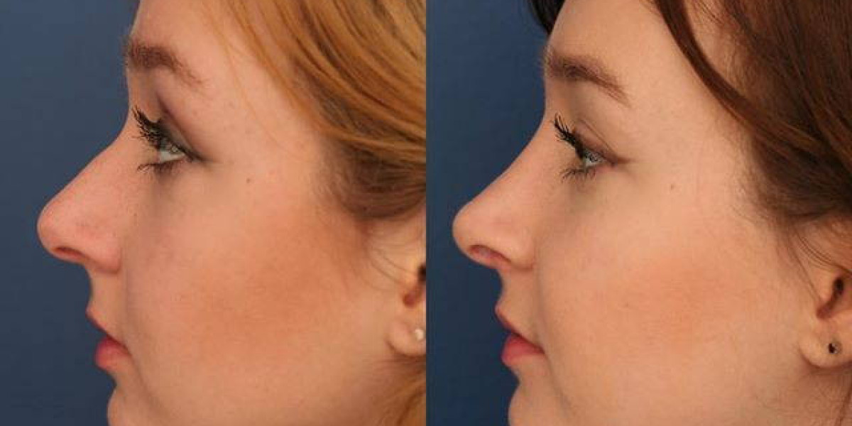 Breathe Better & Look Better with Rhinoplasty in Riyadh