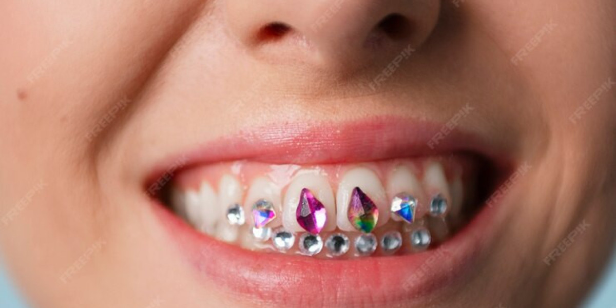 Tooth Gems Near Me: The Hottest Trend in Dental Jewelry