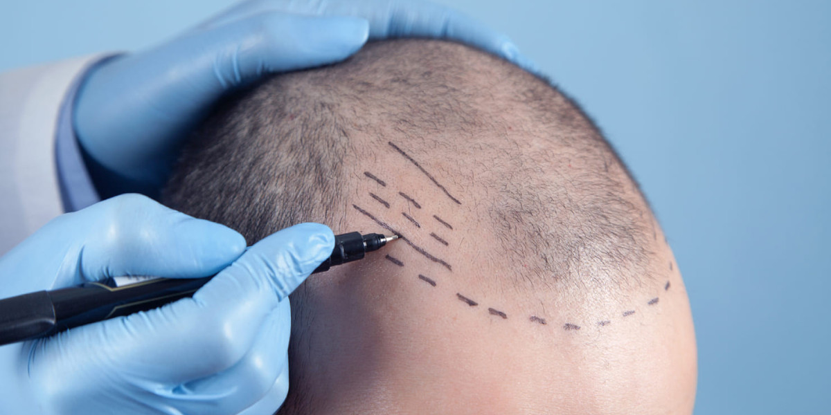 How a Hair Transplant in Riyadh Changed My Life