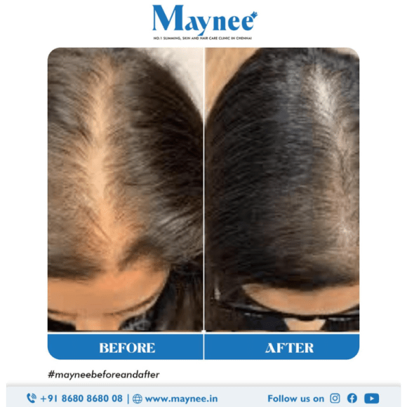 Hair Care Treatment in Chennai, Best Hair Clinic in Chennai