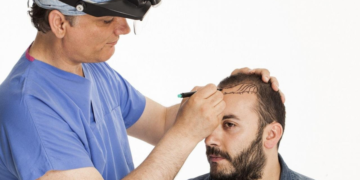 Dealing with Shedding Phase After Hair Transplant in Islamabad