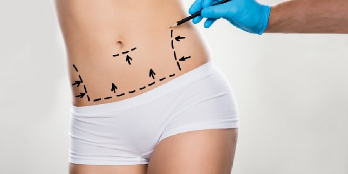 Say Hello to a Sculpted Body with Liposuction in Riyadh