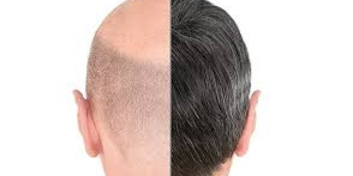 Natural & Permanent Hair Transplant Results in Dubai