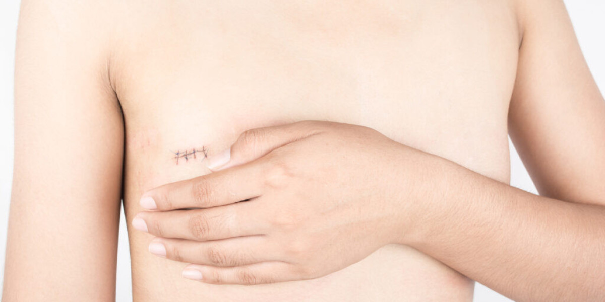 Does Inverted Nipple Surgery Leave Scars