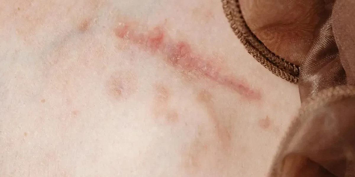 Surgical Scar Revision for Small Scars: Is It Worth It?
